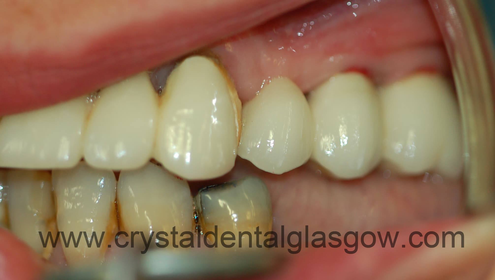 Porcelain bridge on implants Porcelainbridgeonimplants
