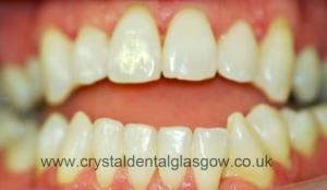 Teeth Whitening After Teeth Whitening After