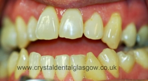 Teeth Whitening Before Teeth Whitening Before