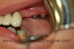 Twodentalimplantsinplace