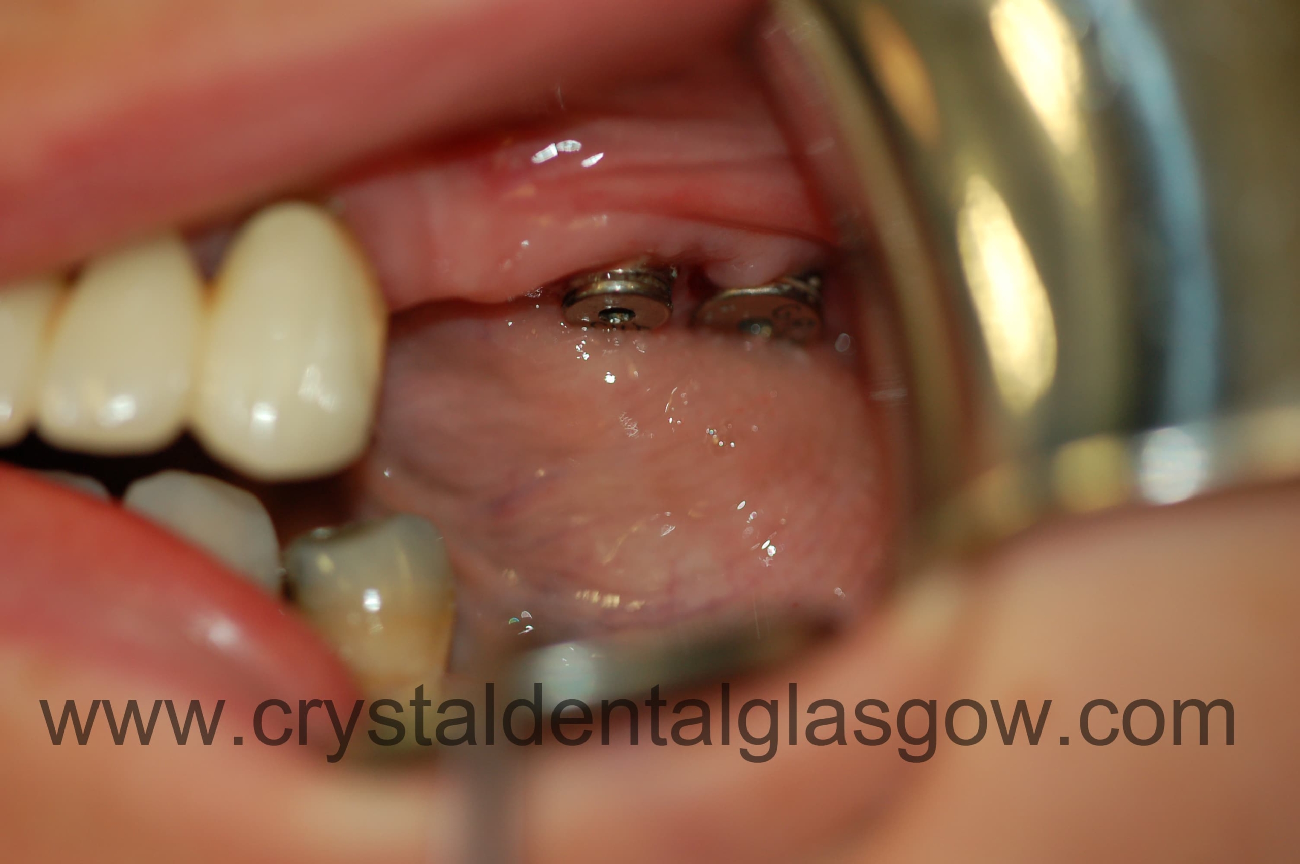 Two dental implants in place Twodentalimplantsinplace