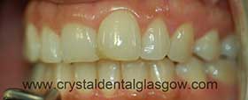 Before Invisalign Before Invisalign