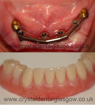 All On 4 Cosmetic Denture on a Titanium Bar All On 4 Cosmetic Denture on a Titanium Bar
