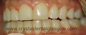 After Invisalign After Invisalign