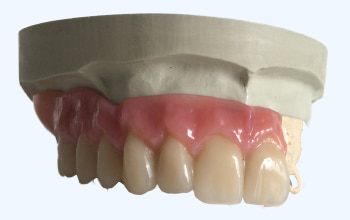 Cobalt Chrome Partial Denture Cobalt Chrome Partial Denture